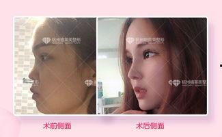 杭州整容爆料案件最新情况,真相逐步浮出水面  第3张